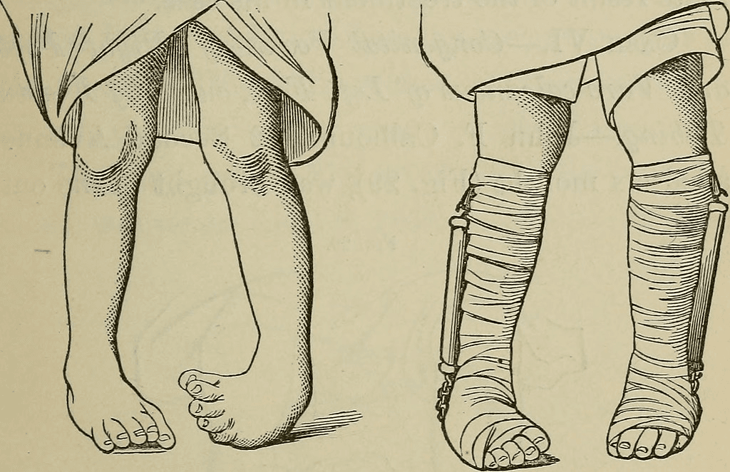 Fixing Clubfeet: Early Intervention to Long-Term Care